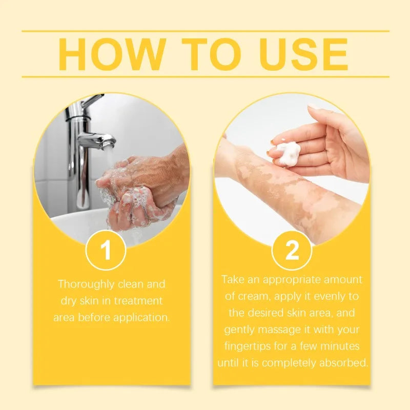 BeeVenom Vitiligo Treatment Cream