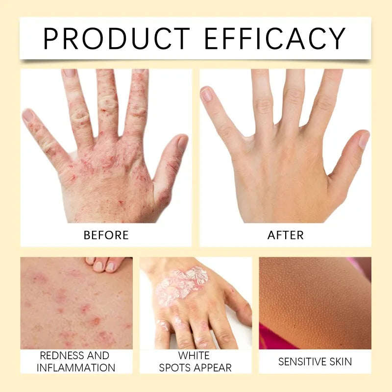 BeeVenom Vitiligo Treatment Cream